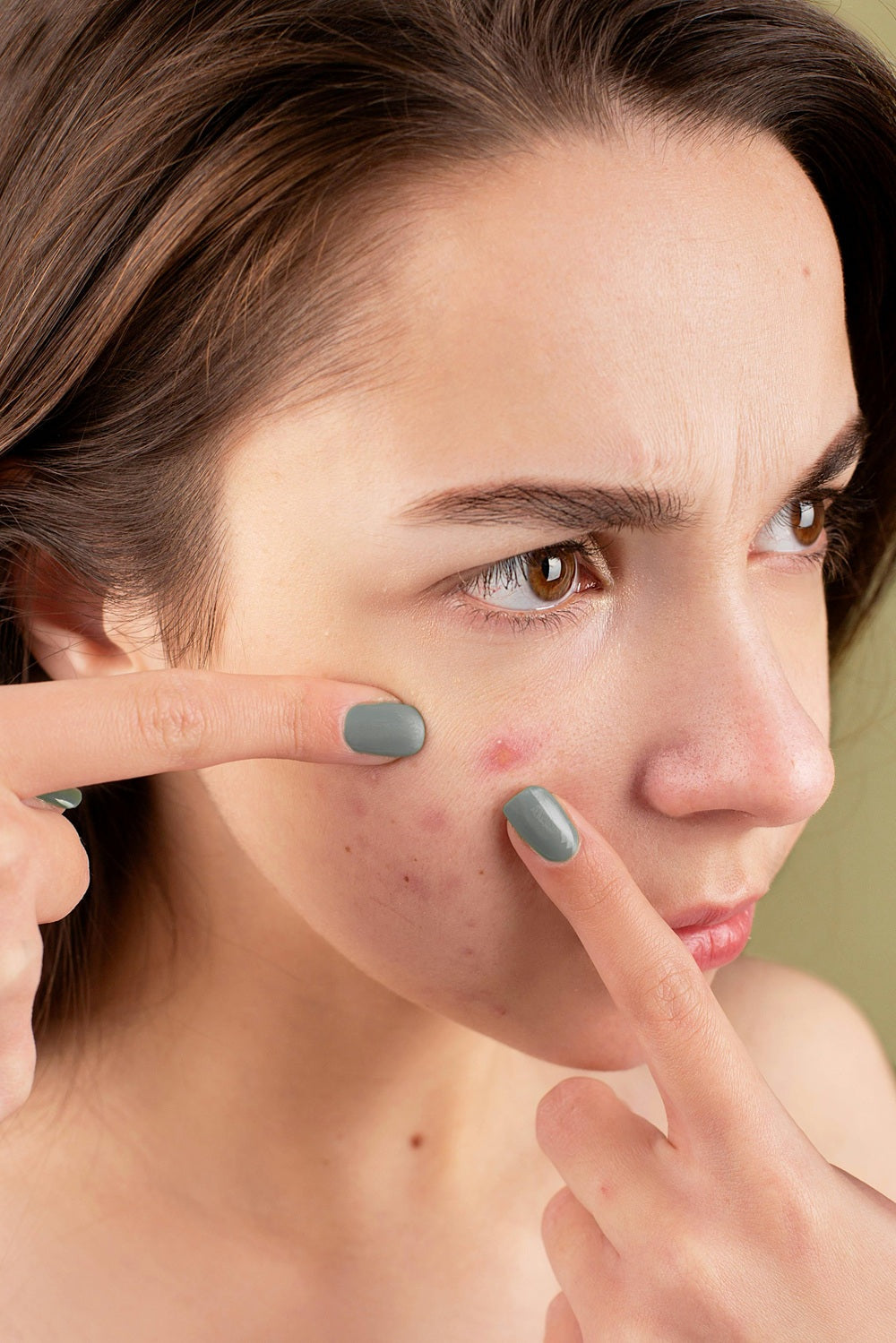 Busting Acne Myths: What You Really Need to Know