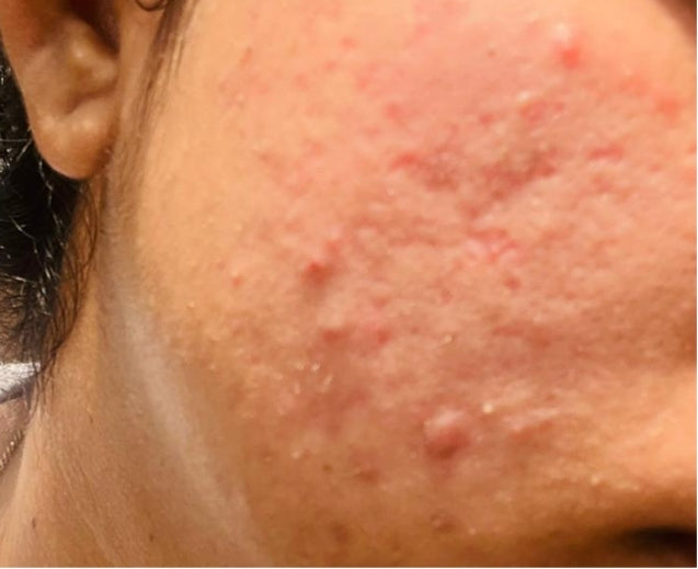 Close-up of skin before using the Face O'Clock One Drop Wonder spot corrector
