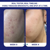 Before-and-after skin comparison showing a person's cheek with acne breakouts at Week 0 and clearer skin at Week 4, presented on a dark blue graphic background with text reading 'REAL TESTER, REAL TIMELINE - VISIBLY REDUCED BREAKOUTS, ONE SPOT AT A TIME.'.